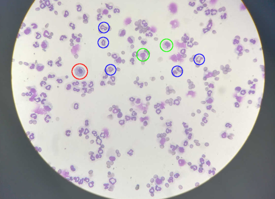 A slice with blood cells shown trough a microscope
                     lens. Some white blood cells are circled, with different colors
                     for neutrophils, lymphocytes and monocytes.
