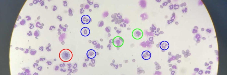 A slice with blood cells shown trough a microscope
                lens. Some white blood cells are circled, with different colors
                for neutrophils, lymphocytes and monocytes.